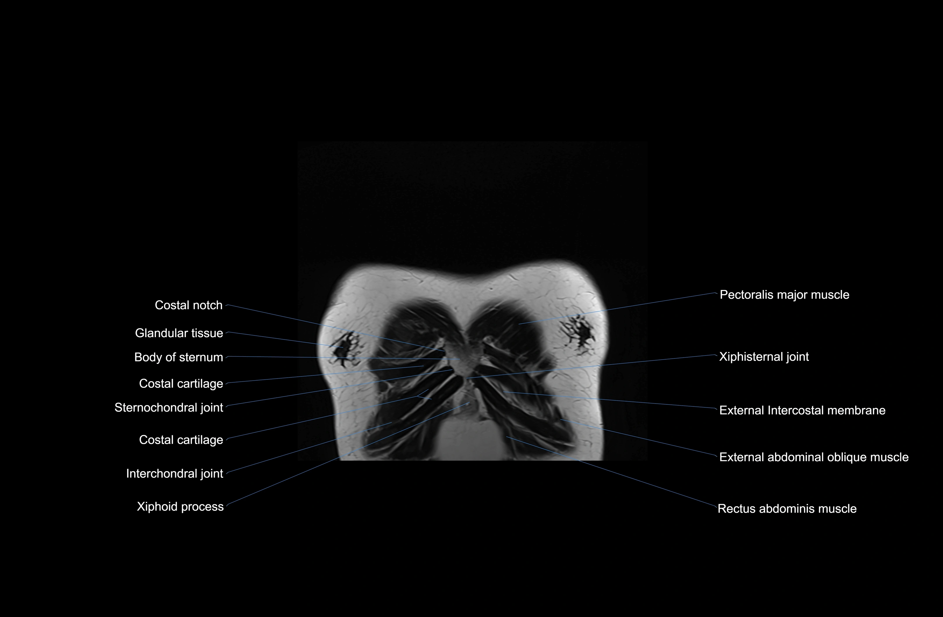 MRI chest (thorax) coronal  cross sectional anatomy 3T radiology  image-img-00001-00004.webp